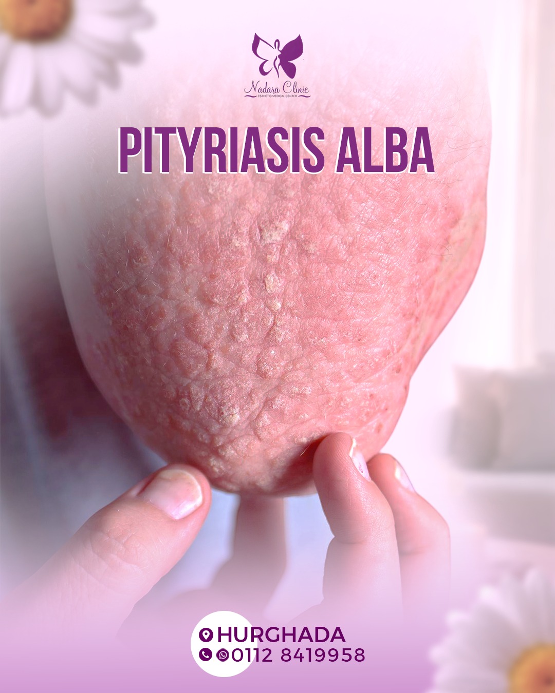 Pityriasis alba in Hurghada